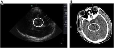 Comparison between Brain Computed Tomography Scan and Transcranial Sonography to Evaluate Third Ventricle Width, Peri-Mesencephalic Cistern, and Sylvian Fissure in Traumatic Brain-Injured Patients